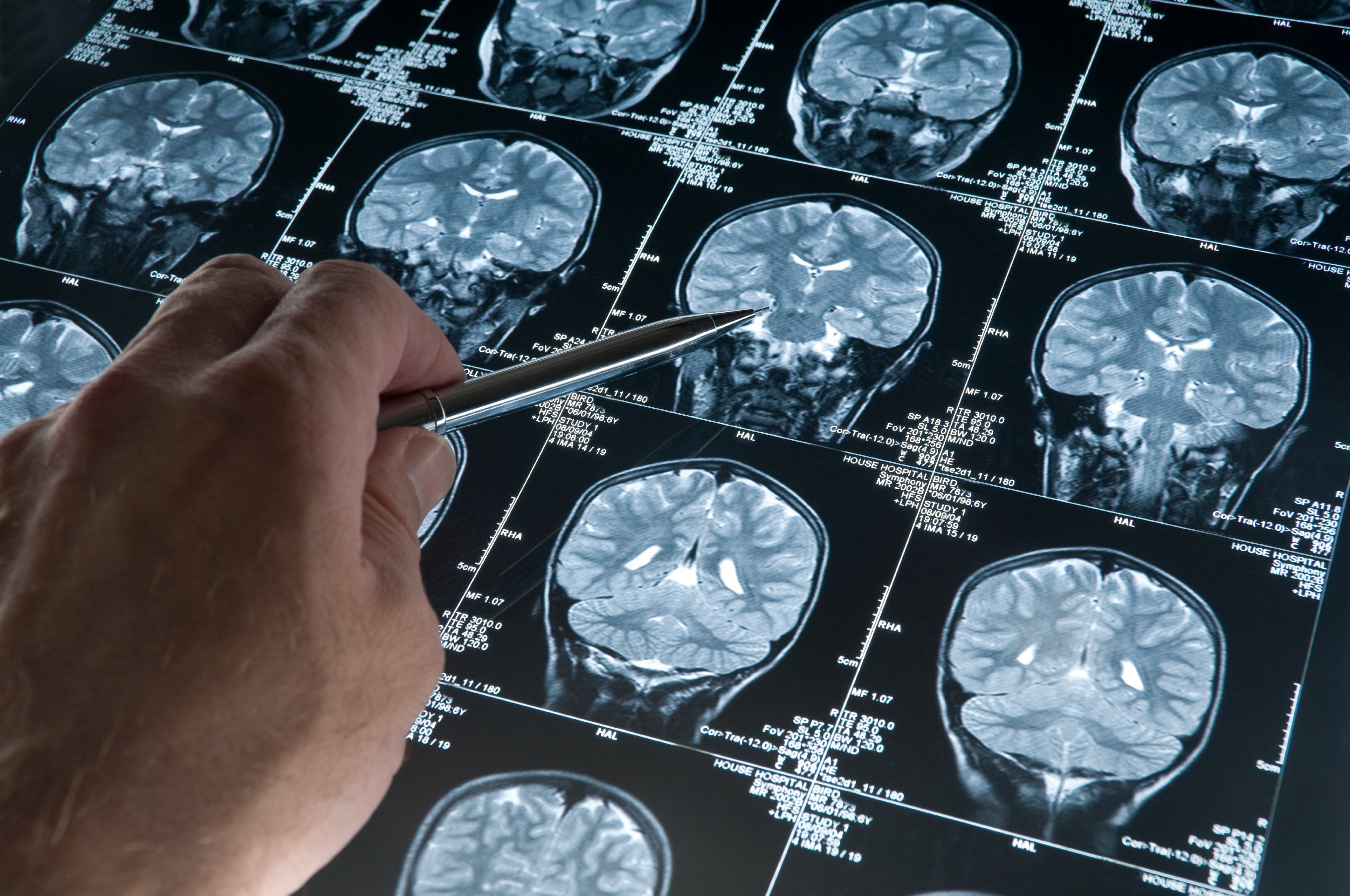 Πρωτοποριακό πρόγραμμα βελτιώνει την εγκεφαλική υγεία ασθενών με Αλτσχάιμερ