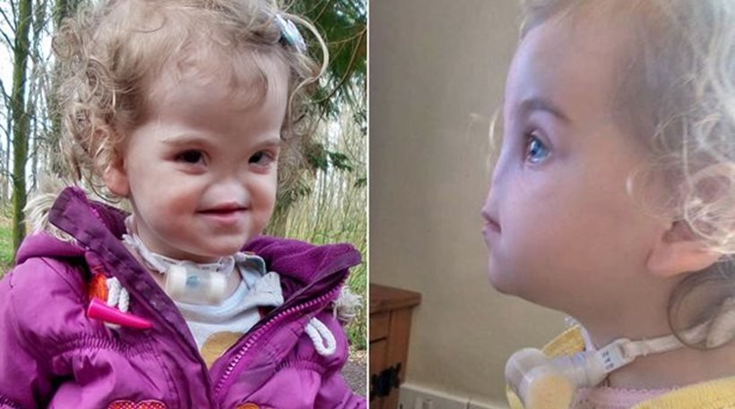 Ένα δίχρονο κοριτσάκι από την Ιρλανδία θα είναι η πρώτη ασθενής στον κόσμο που θα αποκτήσει μύτη από 3D εκτυπωτή! (φωτό)