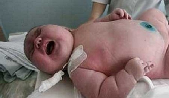 Γυναίκα 270 κιλών γέννησε μωρό 18 κιλών!