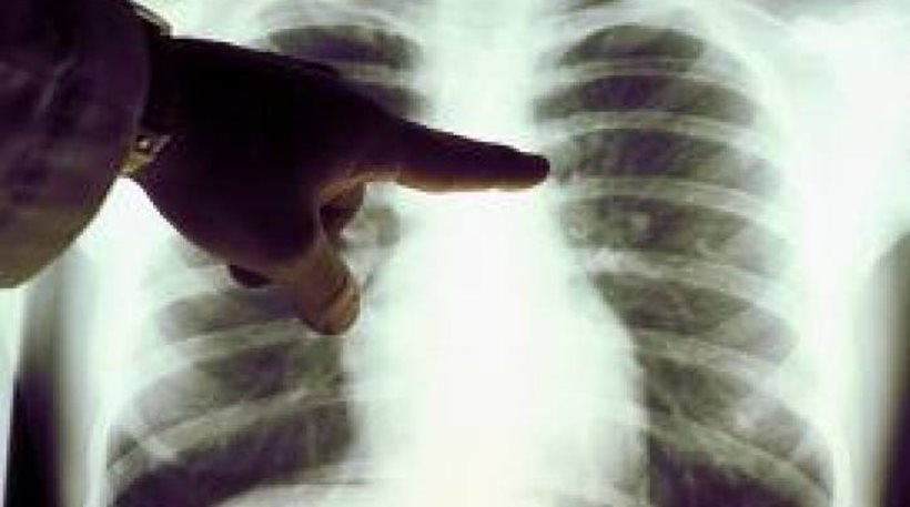 Νέα διαγνωστική εξέταση για την αναγνώριση των ασθενών με καρκίνο του πνεύμονα