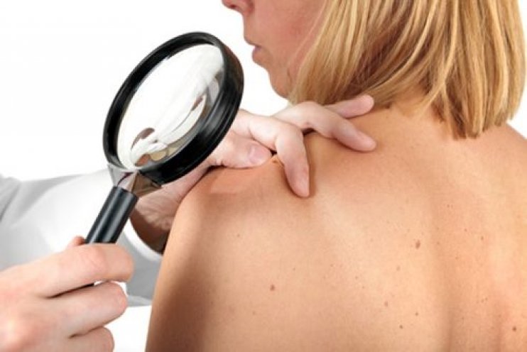 Πώς να προλάβετε τον καρκίνο του δέρματος και το μαλάνωμα