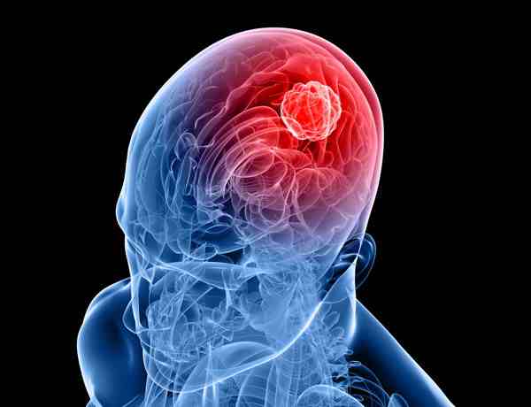 Εγκεφαλικοί όγκοι: Ποια είναι τα συμπτώματα;