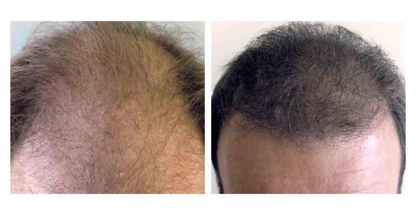 Αλματώδης αύξηση στη μεταμόσχευση μαλλιών