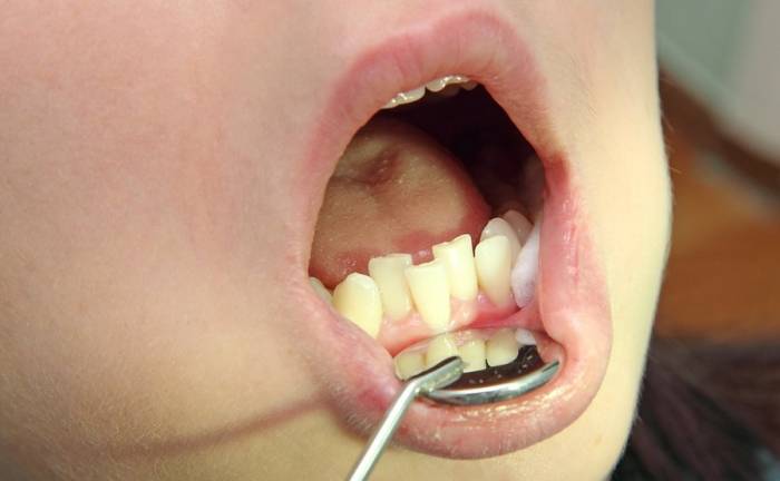 Κακή υγιεινή δοντιών στο 80% των παιδιών στην άγονη γραμμή