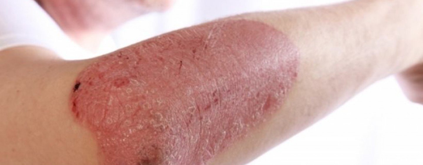 Καθαρό δέρμα έως 3 χρόνια σε ασθενείς με ψωρίαση σύμφωνα με νεότερα δεδομένα