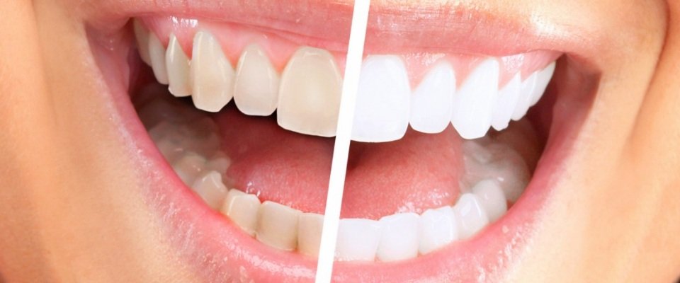 Πώς να κάνετε λεύκανση δοντιών γρήγορα και ανώδυνα