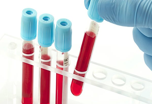 Ποιες είναι οι 7 αιματολογικές εξετάσεις που πρέπει να κάνει κάθε 50άρης