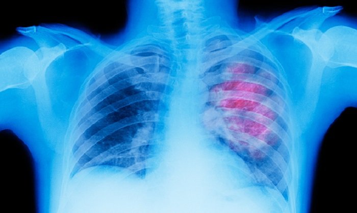Ο «άγνωστος» ρόλος της διατροφής στην εκδήλωση καρκίνου του πνεύμονα