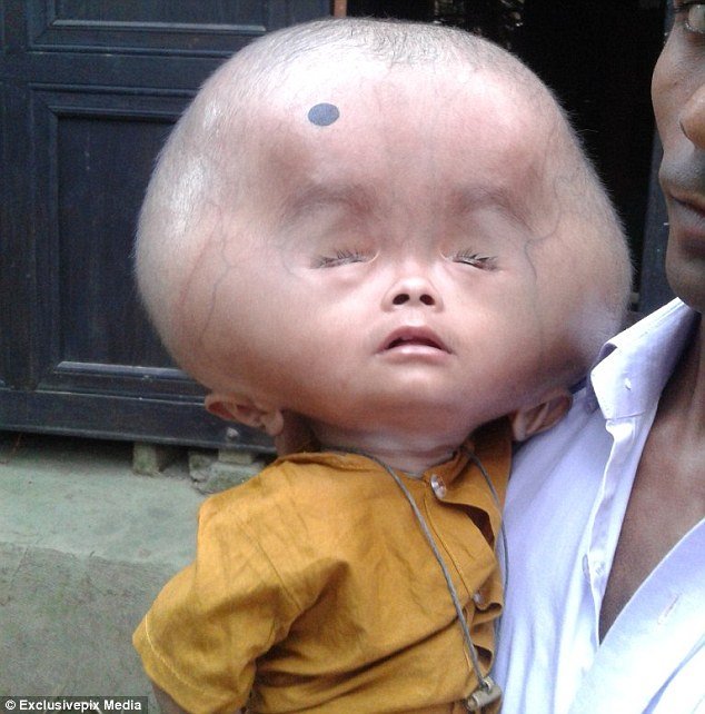 Αυτό το παιδί είναι δύο ετών και το κεφάλι του ζυγίζει 9 κιλά