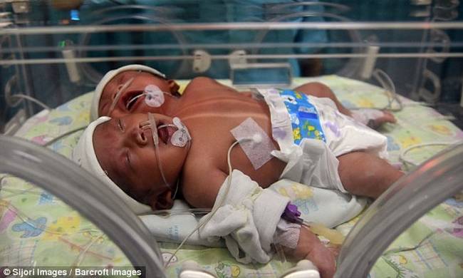 Απίστευτο: Μωρό με δύο κεφάλια γεννήθηκε στην Ινδονησία! (Pics & Vid)