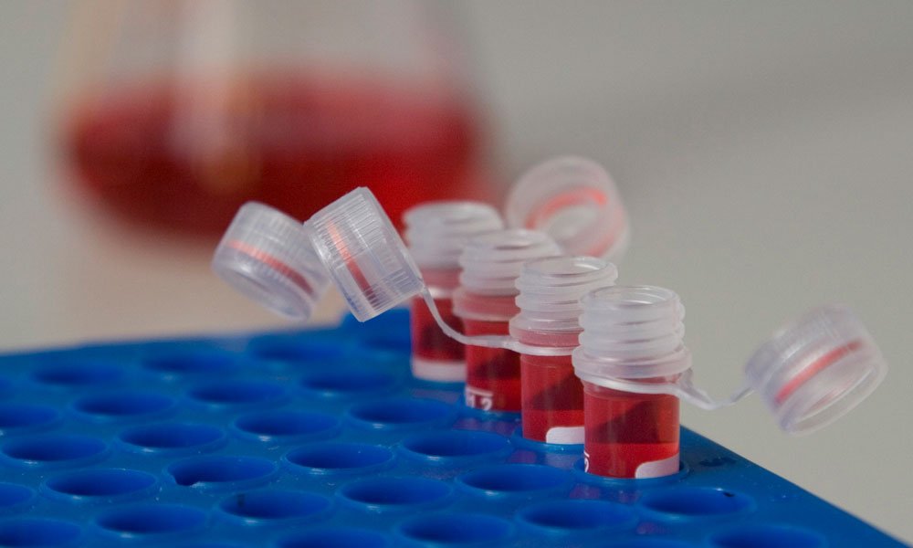 Υπό ανάπτυξη ένα τεστ αίματος για την πρόωρη διάγνωση της οστεοαρθρίτιδας