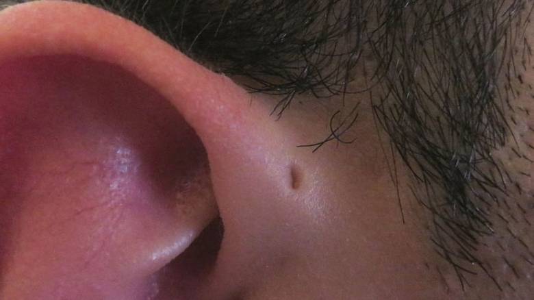 Τι είναι αυτή η μικρή τρύπα που έχουν μερικοί άνθρωποι στο αυτί τους;