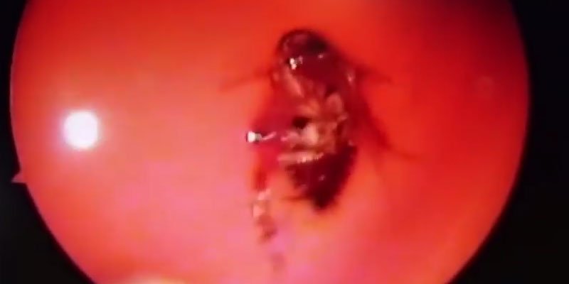 Απίστευτο: Αφαίρεσαν ζωντανή κατσαρίδα από τη μύτη γυναίκας! (βίντεο)