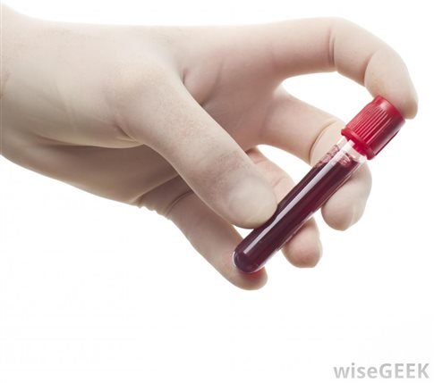 Νέο τεστ αίματος θα βοηθά στην ταχύτατη διάγνωση του καρκίνου