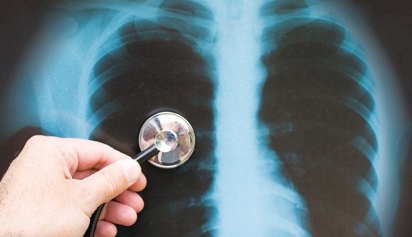 Καρκίνος πνεύμονα: 7 σημάδια που δεν πρέπει να αγνοείτε