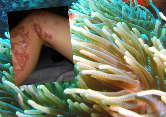 (photo) Σοκάρουν οι εικόνες από "επίθεση" θαλάσσιας ανεμώνης σε παιδί