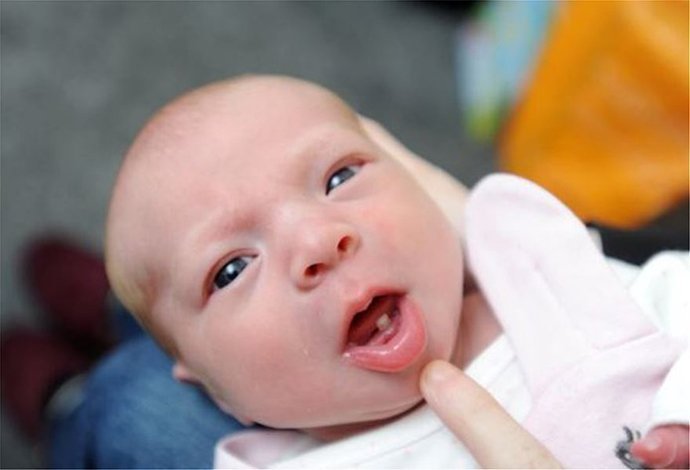 Βρετανία: Γεννήθηκε μωρό με "γενέθλιο" δόντι!