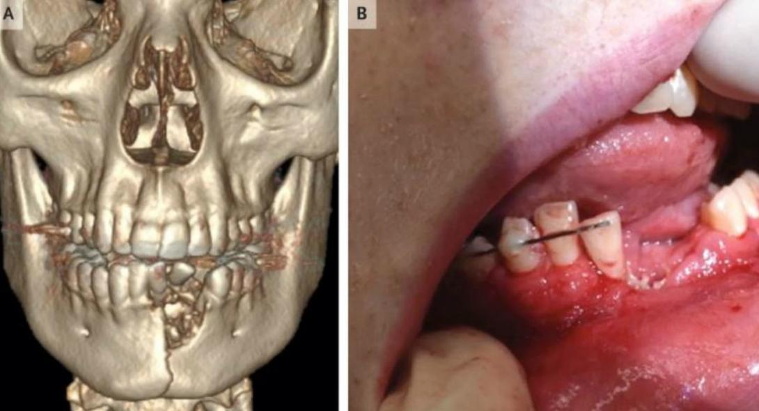 Έσπασε τα δόντια και το σαγόνι του από ηλεκτρονικό τσιγάρο! Έσκασε στο στόμα του!