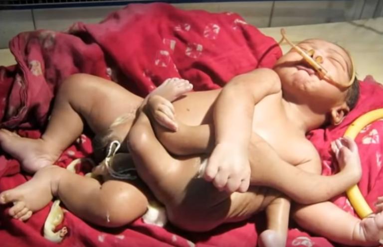 Ινδία: Κοριτσάκι γεννήθηκε με 4 πόδια και 3 χέρια!