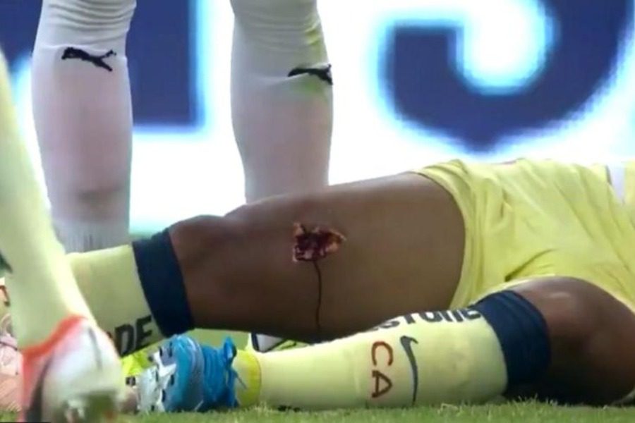 Ένας από τους πιο ανατριχιαστικούς τραυματισμούς στο ποδόσφαιρο! Δείτε σε βίντεο τι έπαθε ο Τζιοβάνι Ντος Σάντος