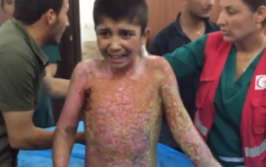 Φρίκη! Βίντεο-ΣΟΚ παιδιού με καμμένη τη σάρκα του από τις βόμβες των Τούρκων!