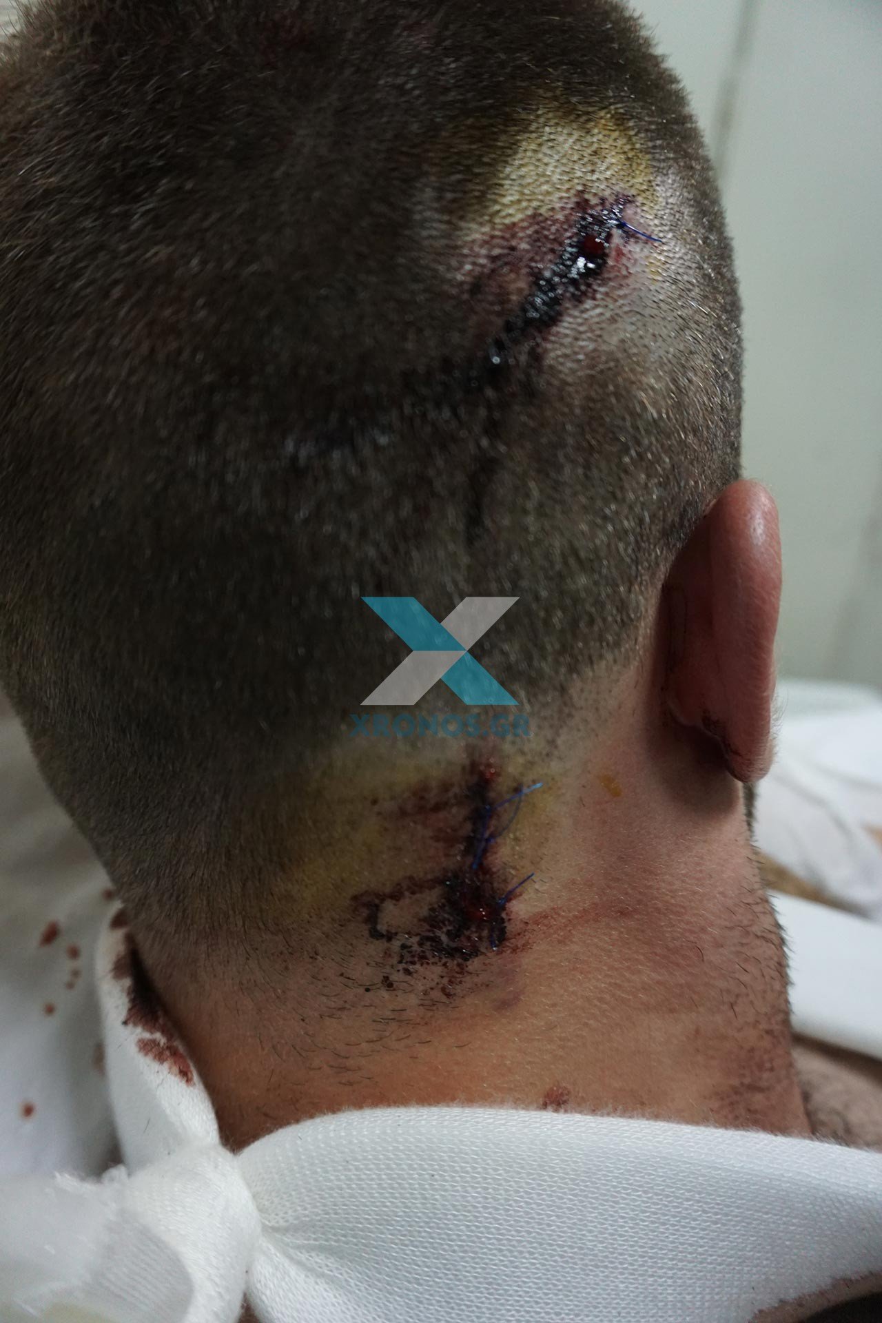 Κομοτηνή: Φωτογραφίες σοκ του αστυνομικού που μαχαιρώθηκε από μετανάστη