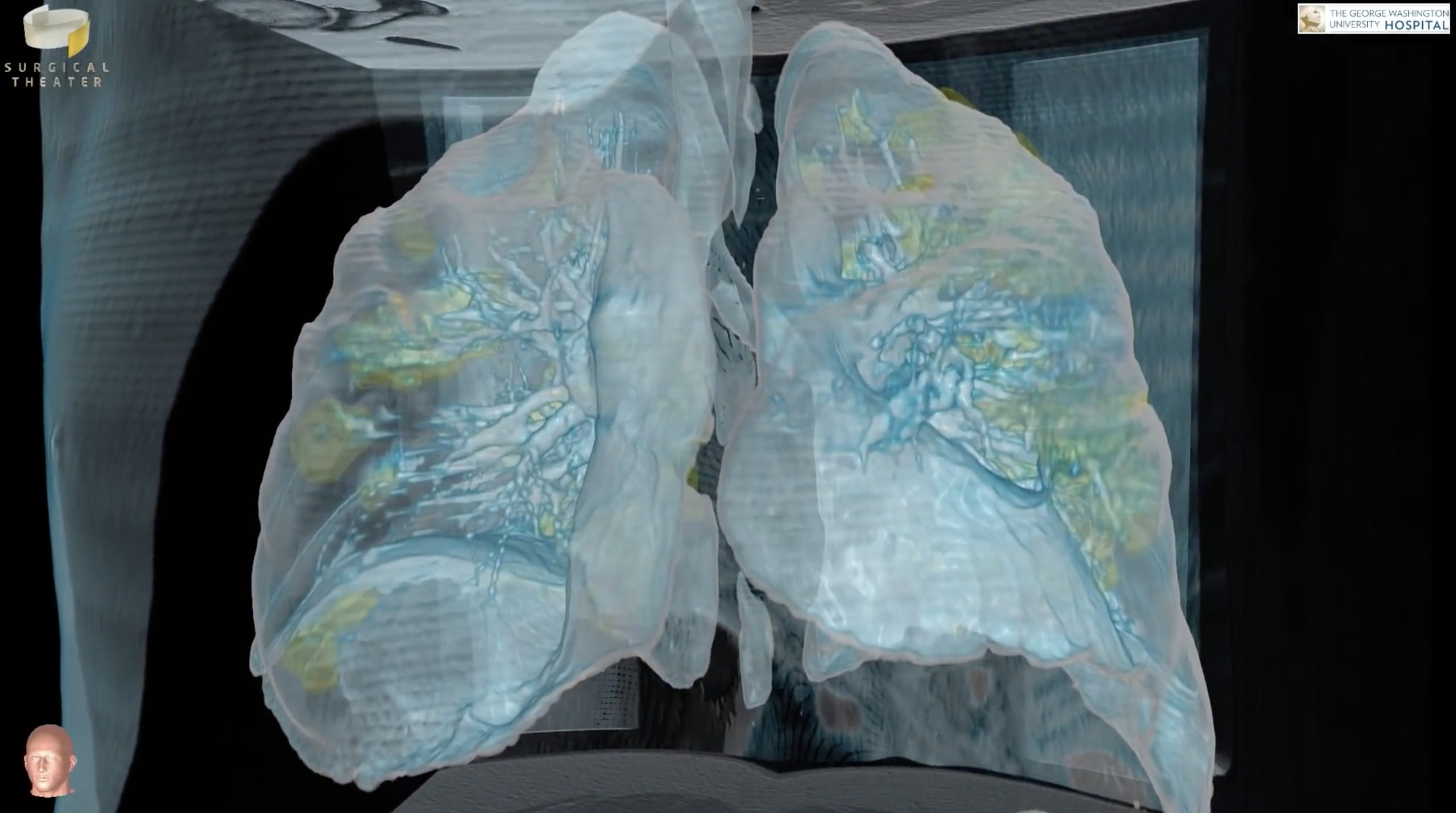 Σοκ: 3D βίντεο δείχνει την ζημιά που προκαλεί ο κορωνοϊός στους πνεύμονες ασθενή