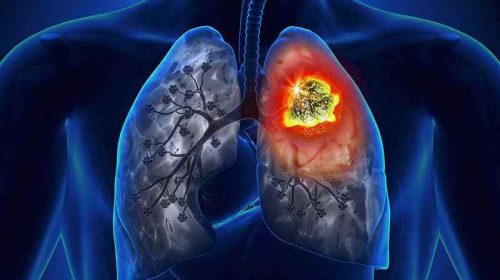 Διαδικτυακή ημερίδα για τον Καρκίνο του Πνεύμονα