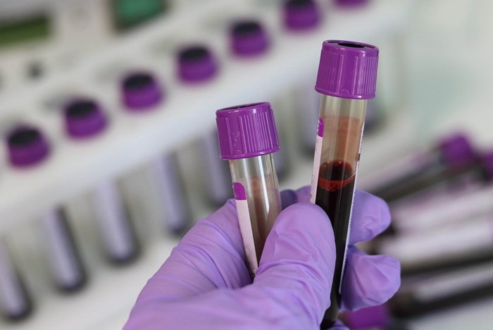 Η Βρετανία ξεκινά τη δοκιμή ενός τεστ αίματος για την ανίχνευση περισσότερων από 50 ειδών καρκίνου