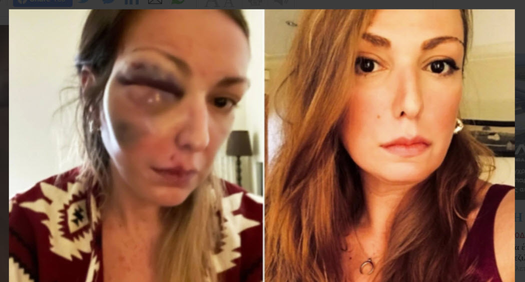 Θύμα κακοποίησης από το σύντροφο της η food blogger, Στεφανία Τζαφέρη - Σοκαριστικές φωτογραφίες