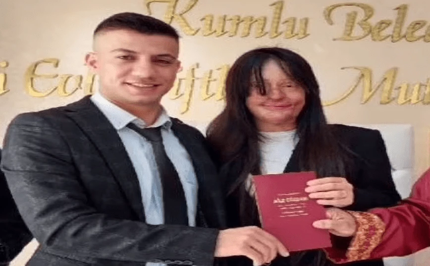 Τουρκία βιτριόλι: Γυναίκα παντρεύτηκε τον άνδρα που της έριξε οξύ στο πρόσωπο – Σάλος στα social media