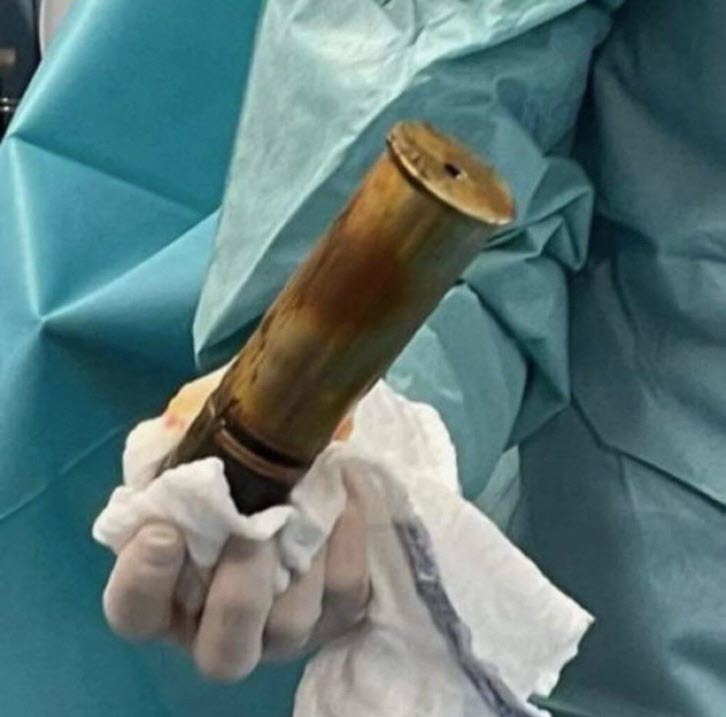 Γαλλία: Σοκ - 88χρονος ασθενής πήγε στα επείγοντα νοσοκομείο με οβίδα στον πρωκτό – Εκκενώθηκε το νοσοκομείο